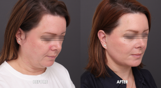 Face neck lift patient6 4