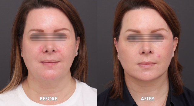 Face neck lift patient6 5