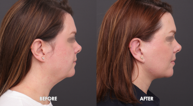 Face neck lift patient6