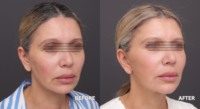 Face neck lift patient