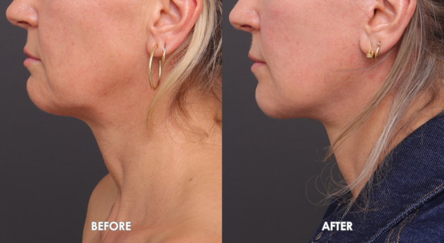 Face neck lift patient