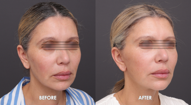 Face neck lift patient