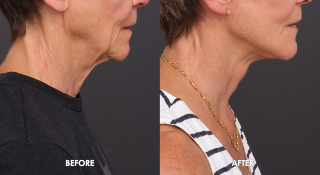 Face neck lift patient