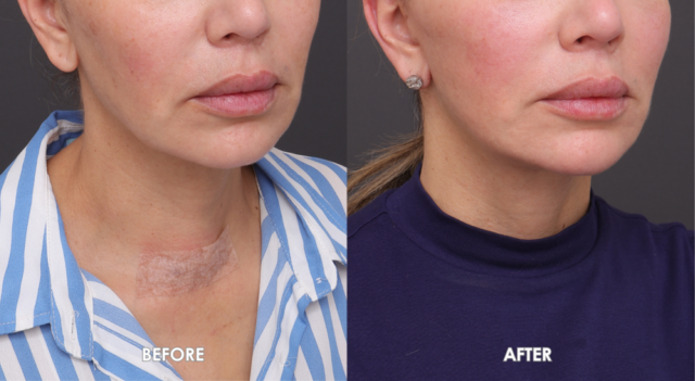 Face neck lift sydney 45