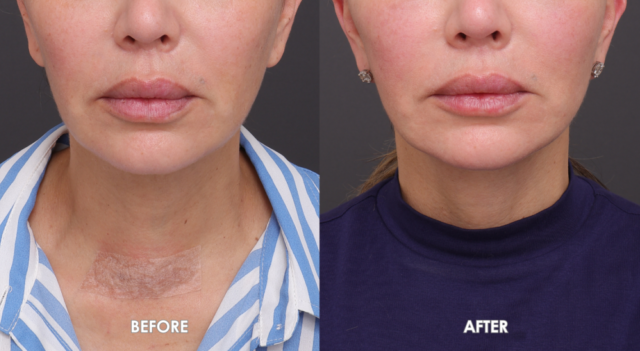 Face neck lift sydney front