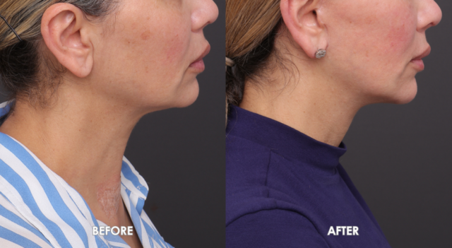 Face neck lift sydney side
