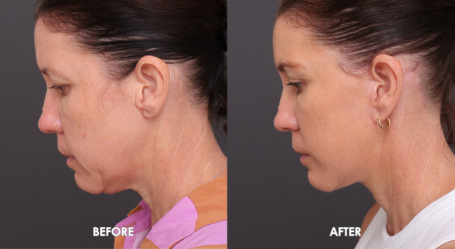 Face neck lift sydney