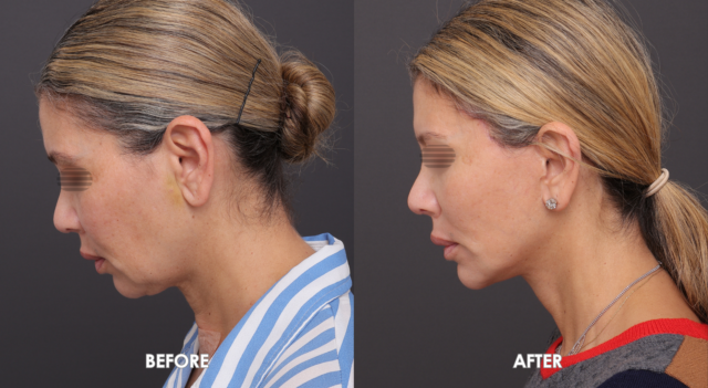 Face neck liftpatient 1