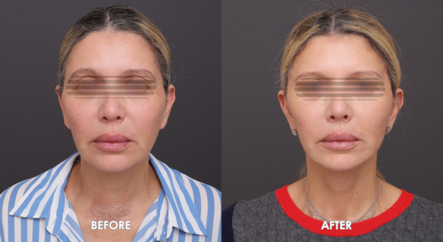 Face neck liftpatient 2