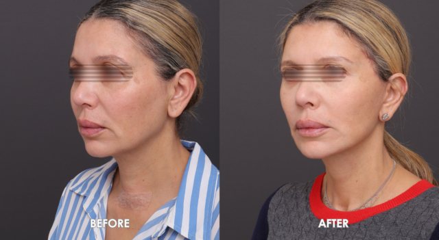 Face neck liftpatient 4