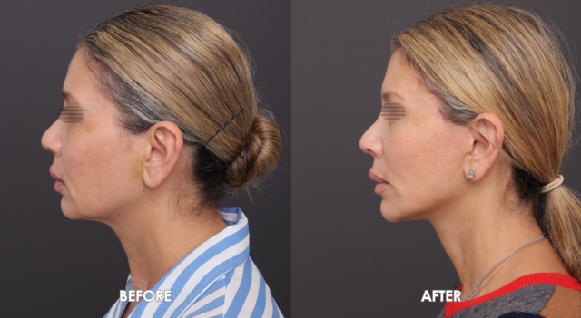 Face neck liftpatient 5