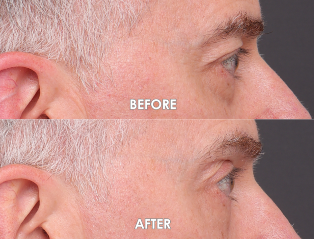 Lower blepharoplasty sydney side