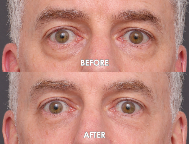 Lower blepharoplasty sydney