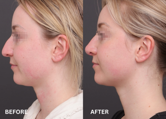 Rhinoplasty patient sydney